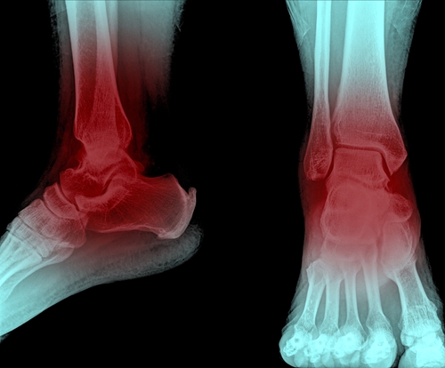Heel Pain Surgery: Plantar Fasciitis - 26 Foot & Ankle